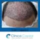 Slider image (9) Clinica Capilar